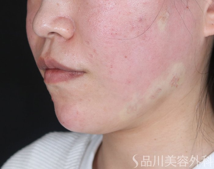 症例NO.72262のAFTER写真