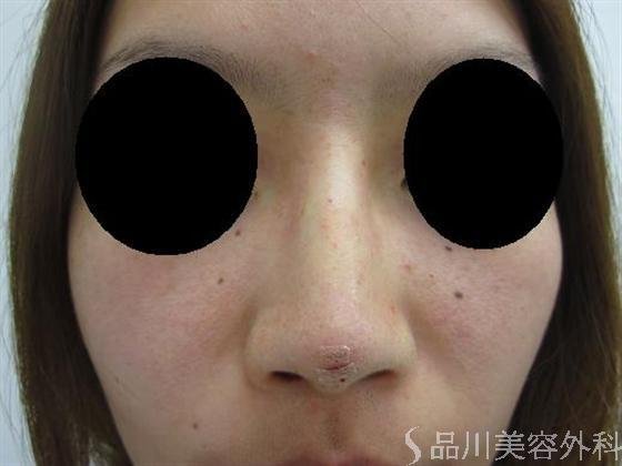 症例NO.10054のAFTER写真