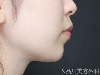 症例NO.73070のAFTER写真