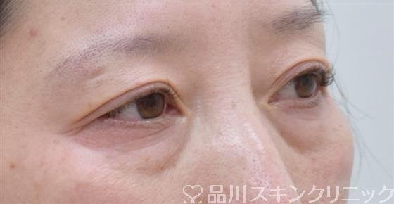 症例NO.58940のBEFORE写真