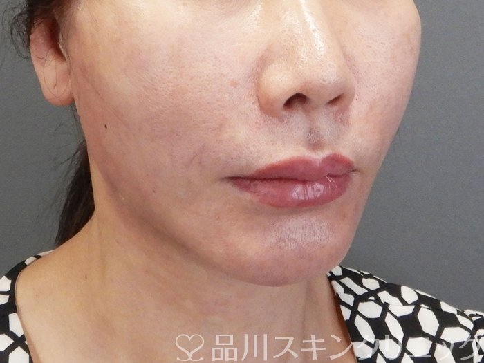症例NO.75178のAFTER写真