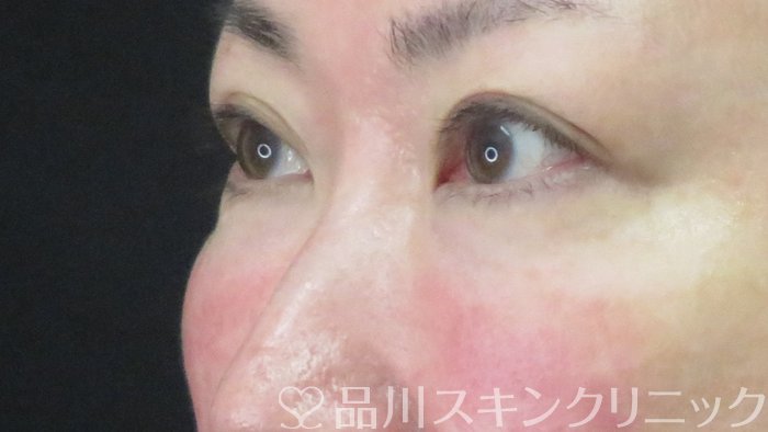 症例NO.72441のAFTER写真