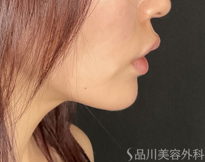 症例NO.75046のAFTER写真