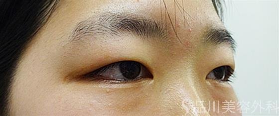 症例NO.34412のBEFORE写真