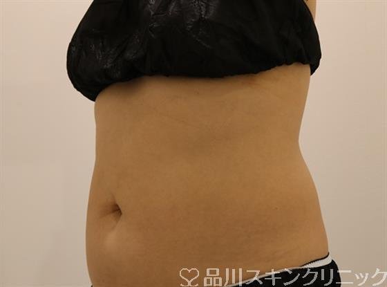 症例NO.43616のBEFORE写真