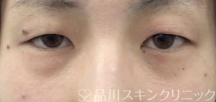 症例NO.63642のBEFORE写真