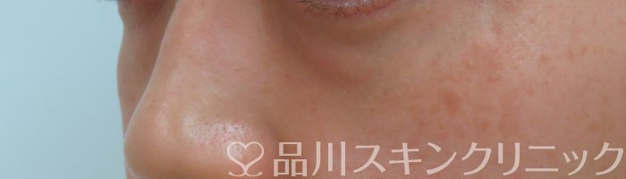 症例NO.66520のBEFORE写真
