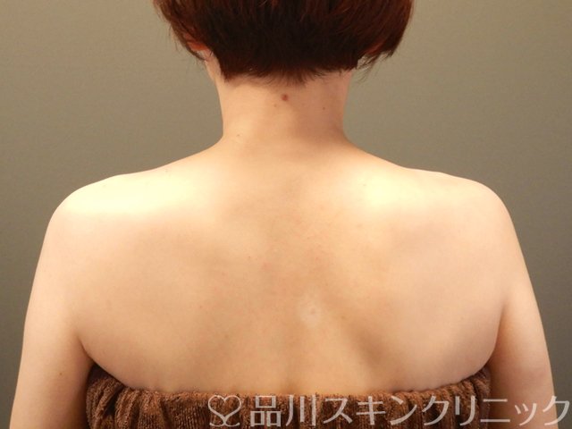 症例NO.67226のBEFORE写真