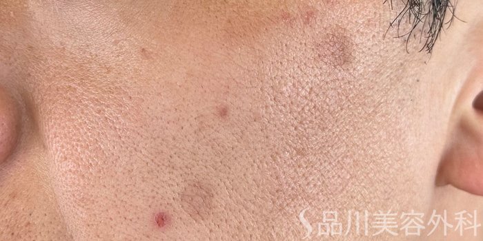 症例NO.71966のBEFORE写真