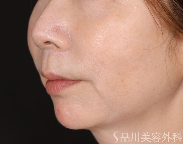 症例NO.71863のAFTER写真