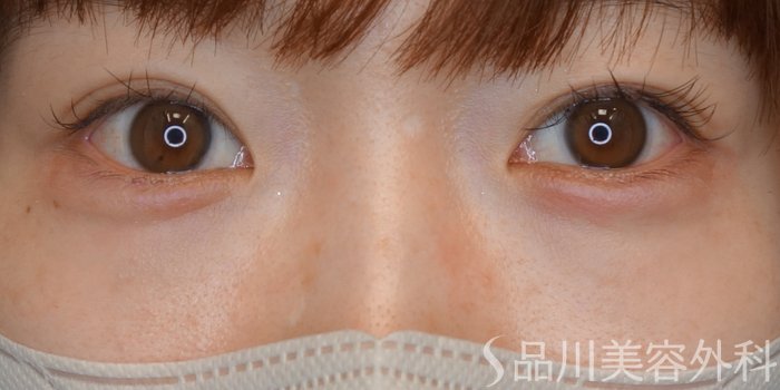 症例NO.70422のAFTER写真