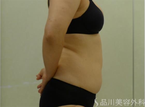 症例NO.41073のAFTER写真