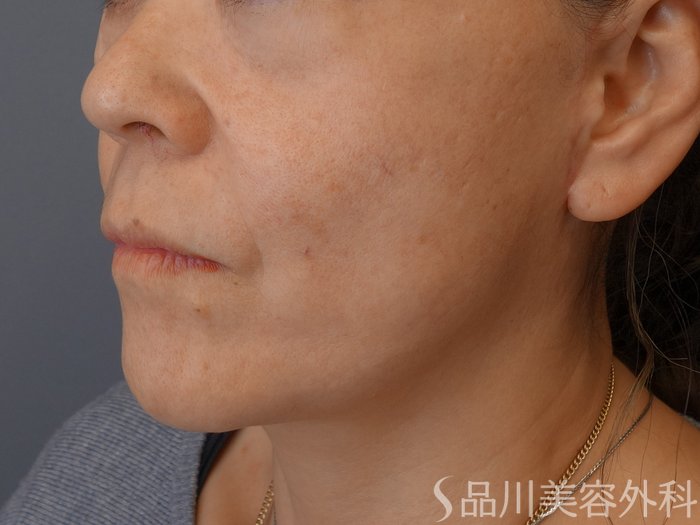 症例NO.74779のBEFORE写真