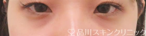症例NO.38698のBEFORE写真