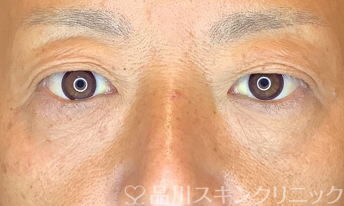 症例NO.74705のAFTER写真