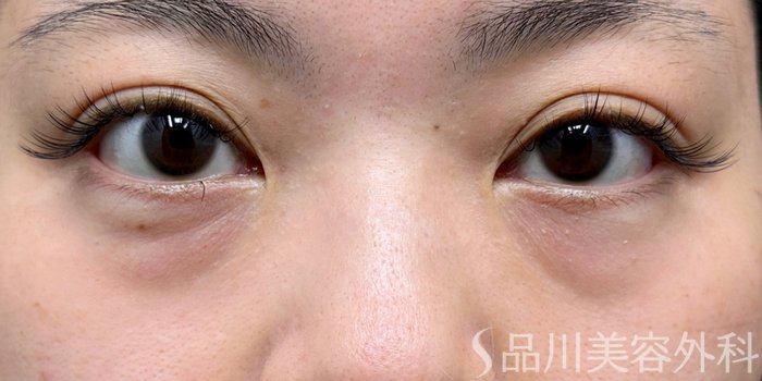 症例NO.74750のBEFORE写真