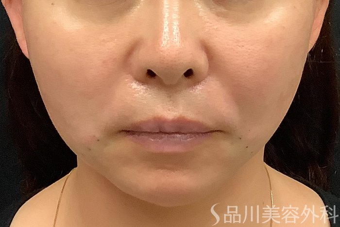 症例NO.71245のAFTER写真