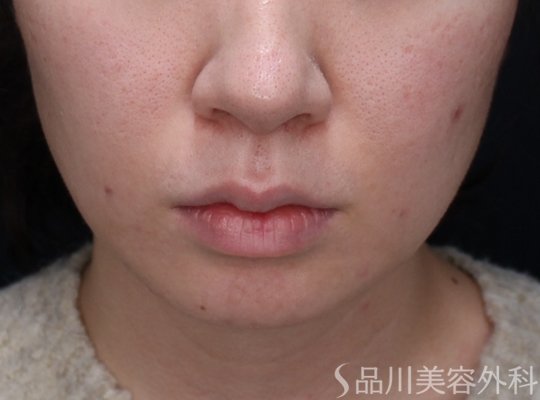 症例NO.73624のBEFORE写真