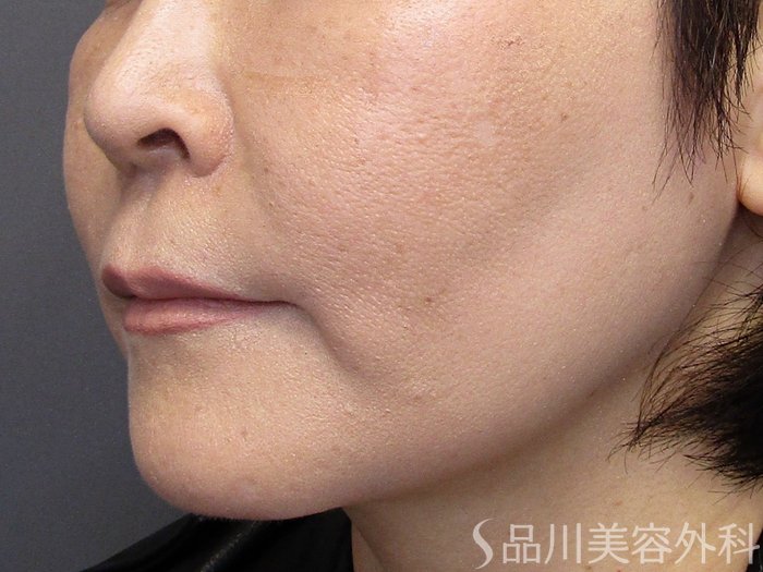 症例NO.75185のBEFORE写真