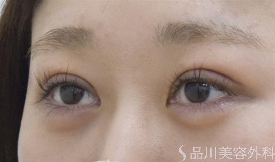 症例NO.52692のAFTER写真