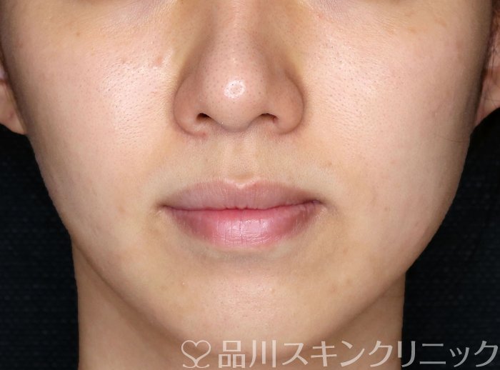 症例NO.70022のAFTER写真