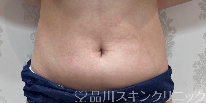 症例NO.69949のBEFORE写真
