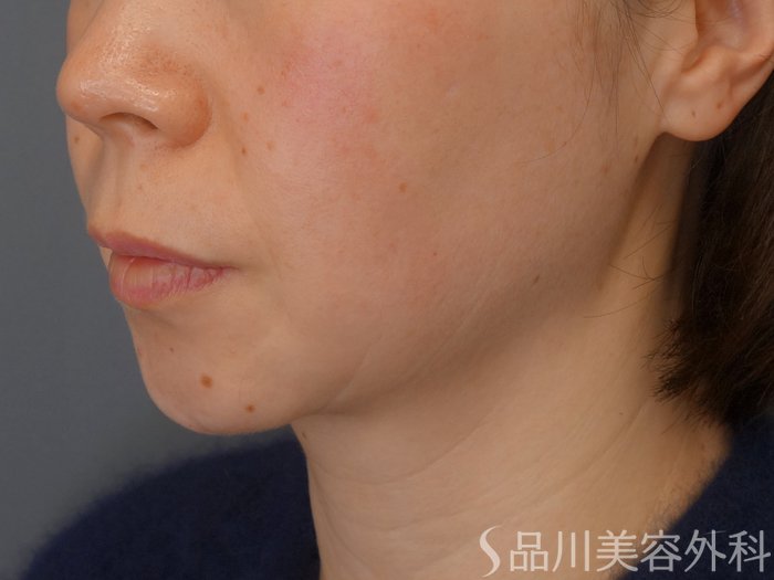 症例NO.69339のBEFORE写真