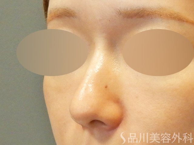 症例NO.67901のBEFORE写真