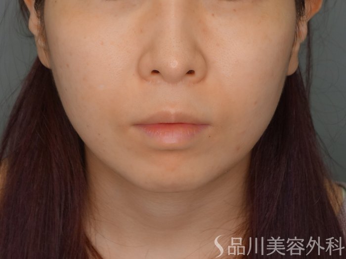 症例NO.74420のBEFORE写真