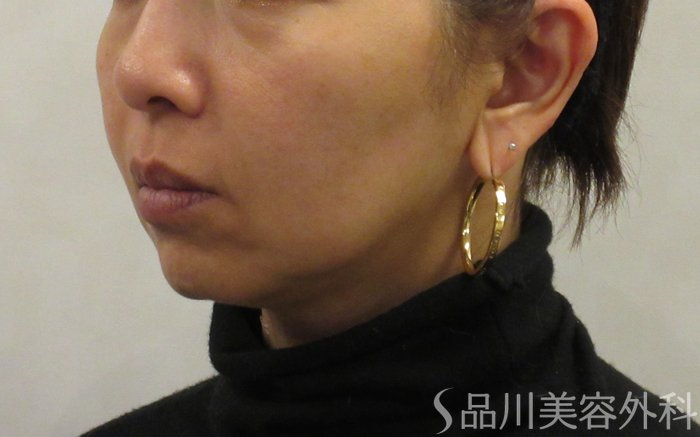 症例NO.73752のBEFORE写真