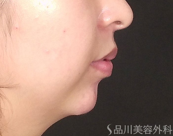 症例NO.65687のAFTER写真