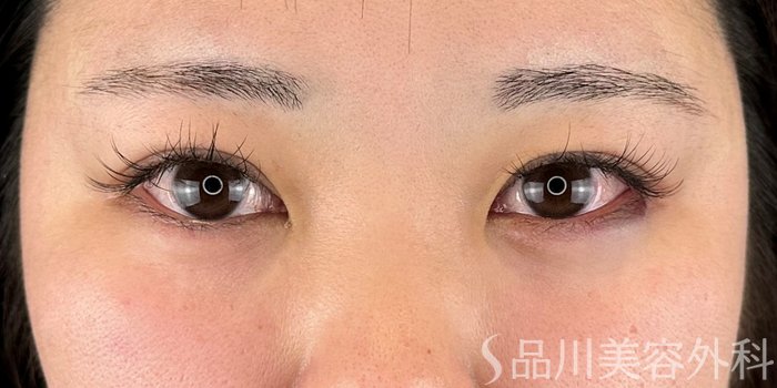 症例NO.70182のAFTER写真