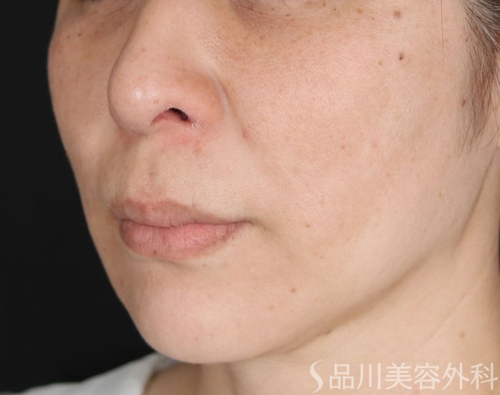 症例NO.73829のBEFORE写真