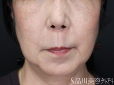 症例NO.71793のAFTER写真