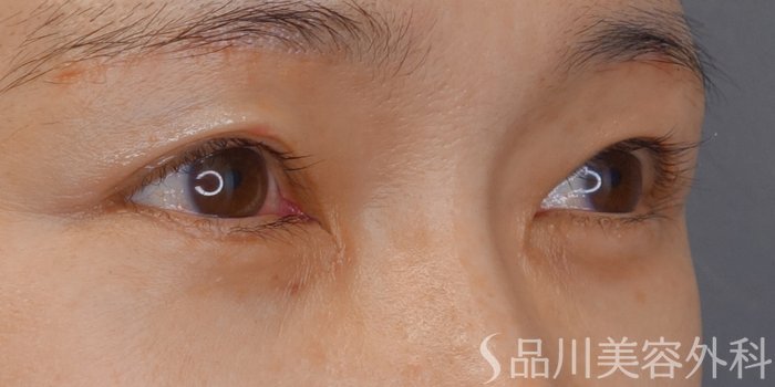 症例NO.70139のAFTER写真