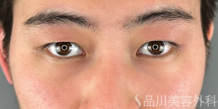 症例NO.69284のBEFORE写真