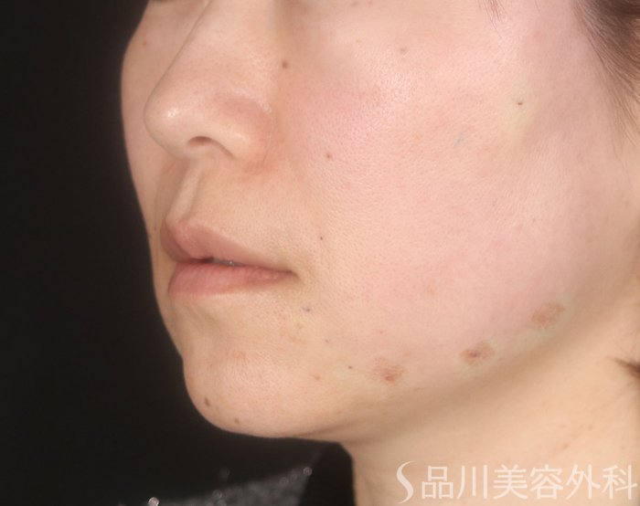 症例NO.73032のAFTER写真