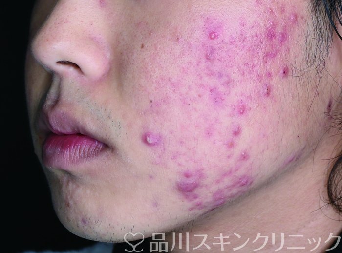 症例NO.73705のBEFORE写真