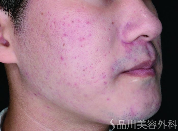 症例NO.69687のBEFORE写真
