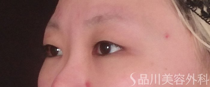 症例NO.70952のBEFORE写真