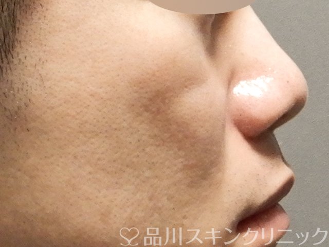 症例NO.68052のBEFORE写真
