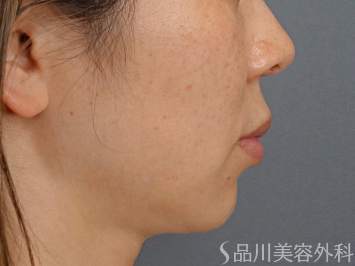 症例NO.73865のBEFORE写真