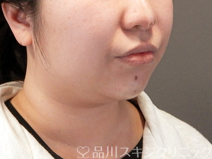 症例NO.64193のAFTER写真