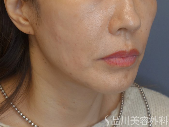 症例NO.72060のAFTER写真