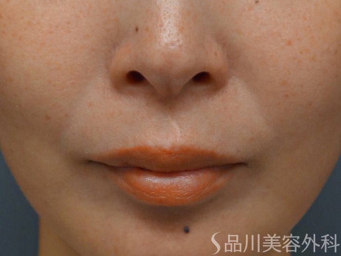 症例NO.66833のBEFORE写真