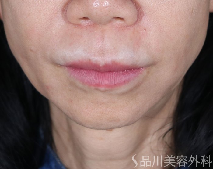 症例NO.73874のBEFORE写真