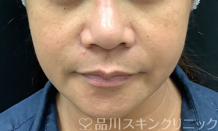症例NO.69378のBEFORE写真