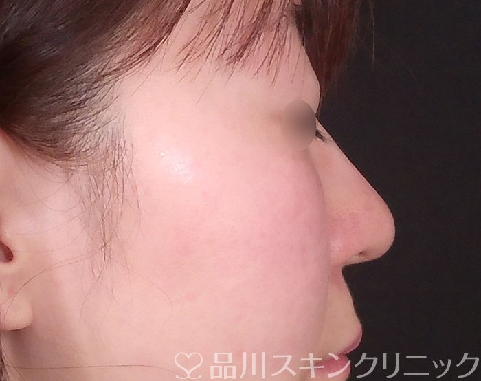 症例NO.69219のBEFORE写真
