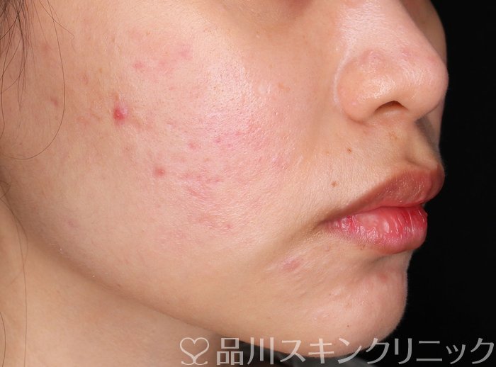 症例NO.72456のAFTER写真