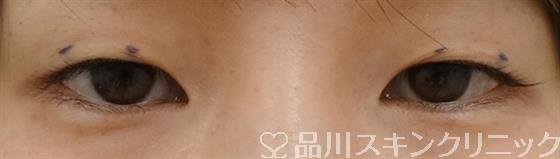 症例NO.32532のBEFORE写真